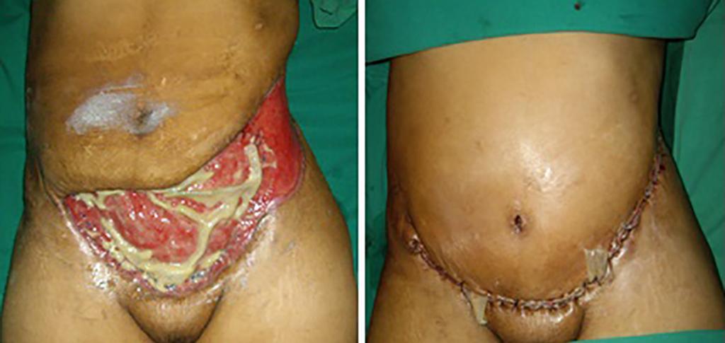 Reconstrução de parede abdominal anterior ou posterior, de maneira laparoscópica ou aberta.