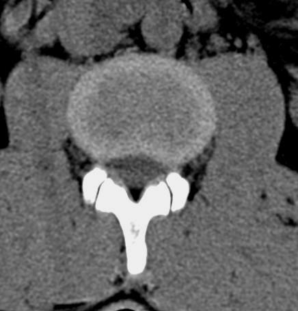 ANATOMIA TOPOGRÁFICA Veia cava inferior Aorta