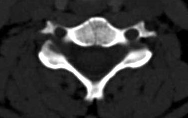 CORPO VERTEBRAL Veia