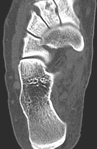 TORNOZELO Cuneiforme intermédio Cuneiforme