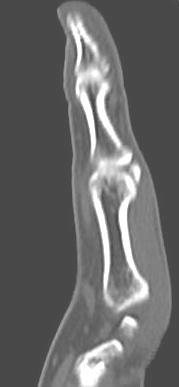 PUNHO / MÃO Falange distal Falange média Articulação interfalangeana distal