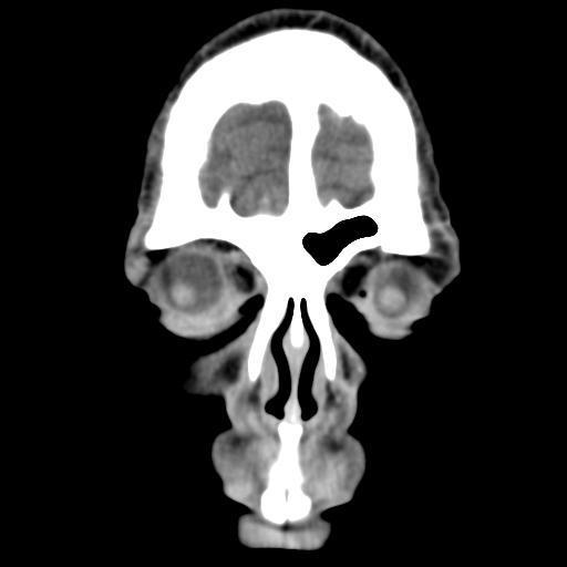SEIOS DA FACE Porção orbital (osso frontal)