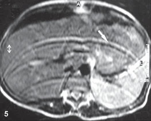 Artefatos de pulsação da aorta (4a) e veia