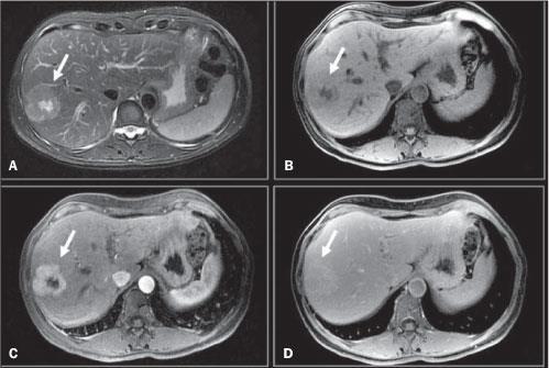 Hperplasia Nodular Focal (HNF) RM: - Hipo em T1 e hipersinal em T2 - Maior sinal na cicatriz central - Estudo