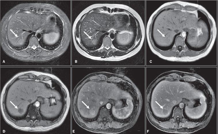 Adenoma RM: - Hiper em T1 e T2 - gordura (out fase) - Estudo dinâmico (GD)