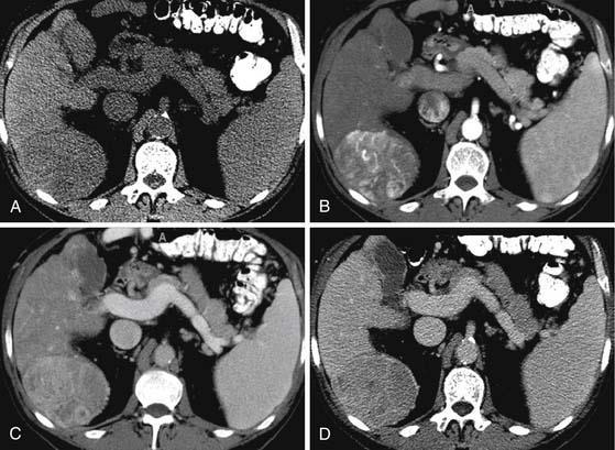 HCC TC - HCC focal: grande, massa hipodensa - gordura/ necrose / calcificação.