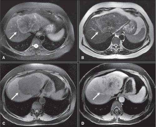 Colangiocarcinoma intra-hepático TC e RM - Massa sólida, lobulada, bem delimitada - Retração capsular (30%) -