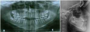 Figura 1. Fotografias iniciais do paciente. Figura 6. Fotografia intrabucal dos mini-implantes instalados vista por palatina. Figura 2.