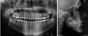 O paciente foi acompanhado mensalmente ate que obteve o resultado esperado, a intrusão dos molares posteriores e fechamento da mordida aberta pela mecânica