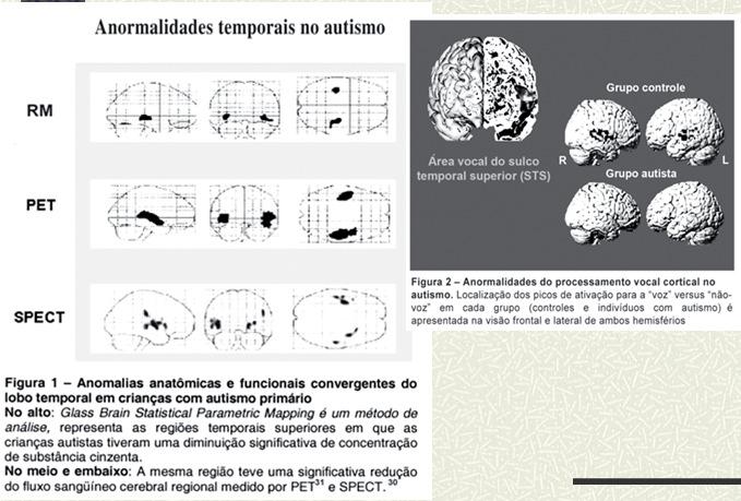 Aspectos Neurológicos do Autismo infantil http://www.polbr.med.br/ano12/prat0512.