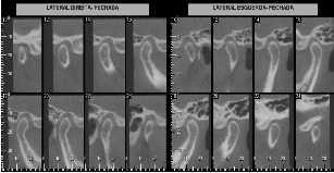 Existem diferentes sinais e sintomas que indicam distúrbio da articulação temporomandibular dentre os quais observa-se a dor da articulação temporomandibular (ATM), disfunção do movimento mandibular