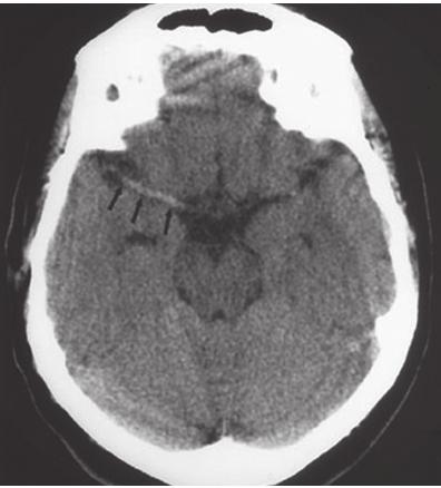 124 ACIDENTE VASCULAR CEREBRAL ISQUÊMICO Figura 1 TC demonstrando hipodensidade no território da artéria cerebral média esquerda. Fonte: Arquivo de imagens dos autores.