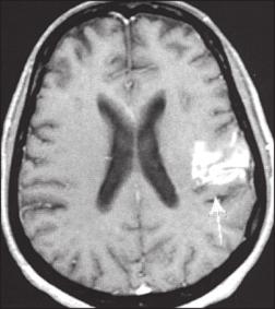 É útil para identificar lesões no território vértebro-basilar e é fundamental no diagnóstico das dissecções arteriais.