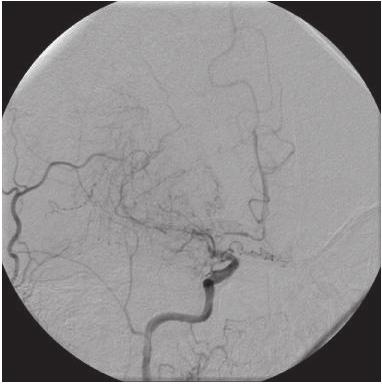 125 PROURGEN SEMCAD Figura 4 Angiografia demonstrando obstrução em território da artéria cerebral média. Fonte: Arquivo de imagens dos autores.