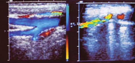 Na carótida direita, o Doppler demonstra obstrução na origem da artéria. Fonte: Arquivo de imagens dos autores.