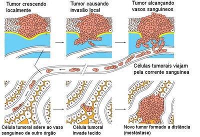 Proliferação tumor primário Invasão local Entrada nos vasos sanguíneos Adesão nos vasos sanguíneos de outros órgãos