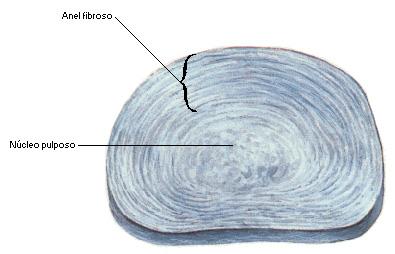 Disco intervertebral é um disco de cartilagem fibrosa presente entre os corpos das