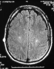 22 Critérios de suporte para o diagnóstico de neuro óptico mielite Figura 2.