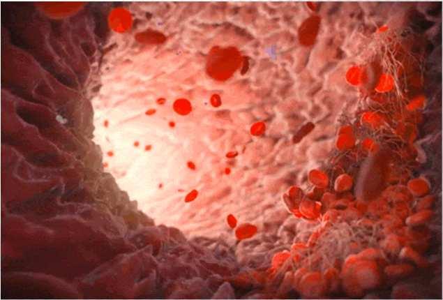 Angina Pectoris ou Angina do Peito Cuidados de Enfermagem - Durante a crise anginosa: Observar o efeito da medicação e possíveis efeitos tóxicos; esses medicamentos geralmente produzem cefaléia,