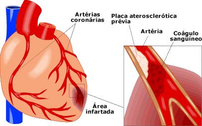 Conceito: É uma necrose isquêmica de uma área de músculo cardíaco ocasionada pela obstrução parcial