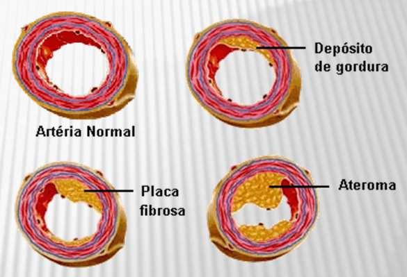 Aterosclerose Coronariana Conceito:
