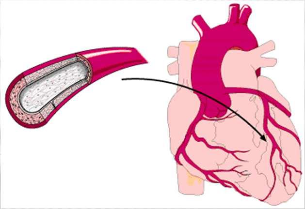 Complicações: Infarto do miocárdio; Angina Pectoris ou Angina do Peito Angina Pectoris ou Angina do Peito Cuidados de Enfermagem - Durante a crise anginosa: Deitar, acalmar o paciente e afrouxar-lhe