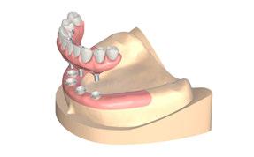 Além disso, envie todos os dados essenciais ao laboratório dentário (dimensão vertical, etc.