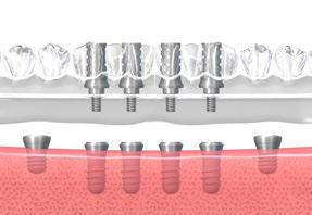 posicionamento dos implantes. Com base no molde da prótese, prepare o modelo mestre.