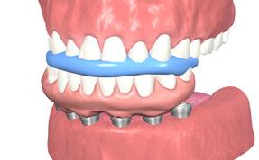 Coloque os pilares de moldagem para moldeira aberta em todos os implantes e assegure-se de que os mesmos assentam devidamente.