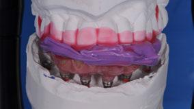 3.10 Ponte final fixa fornecida com CARES Com base na moldagem dentária, prepare o modelo