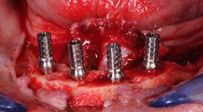 Colocação de 4 implantes TL