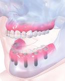 Simples Avançado Complexo Amovível Fixa Maxilar superior LOCATOR sobre 4 implantes Restauração aparafusada fixa sobre