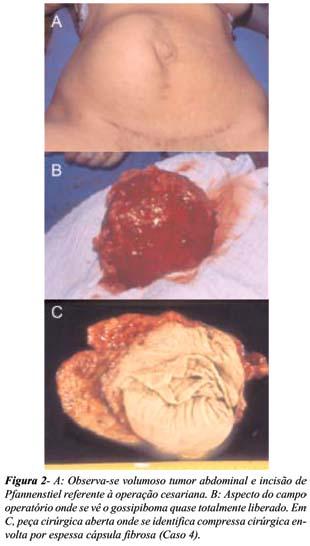 Gossipiboma intra-abdominal