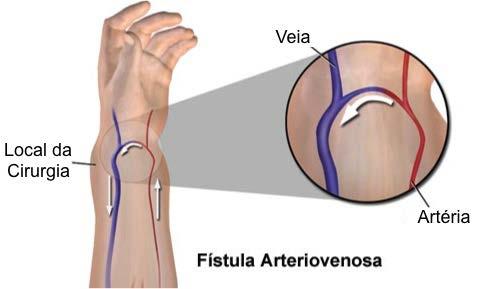 VIAS DE ACESSO A via de acesso para a hemodiálise é exclusivamente vascular, envolvendo artérias e veias, em conjunto ou separado.