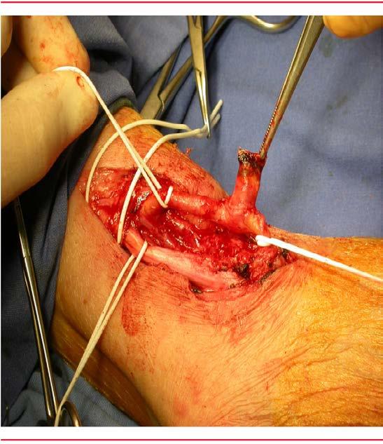 Material necessário para instalação do shunt: instrumental cirúrgico (material para dissecção de veia artéria); anti-sépticos; bisturis; shunt arteriovenoso com conector; fios (sutura); campos
