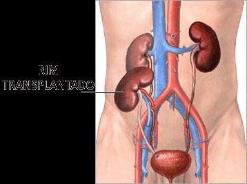 TRANSPLANTE RENAL O tratamento para quem sofre de IRC, pode ser feito através da diálise peritoneal, hemodiálise ou do transplante renal. O que é Transplante Renal?