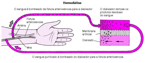 Três princípios regulam a ação da hemodiálise: difusão, osmose e ultrafiltração.