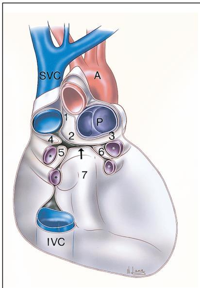 Recessos pericárdicos O pericárdio seroso tem duas reflexões, que foram dois seios: Transverso Envolve Aorta e Pulmonar Obliquo Envolve VCS, VCI e V.