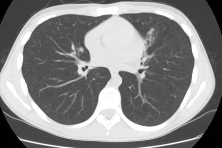 de CO TC torácica incipientes bronquiolectasias e