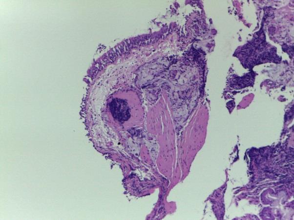 Respiratório Broncofibroscopia sem alterações Razão CD4/CD8