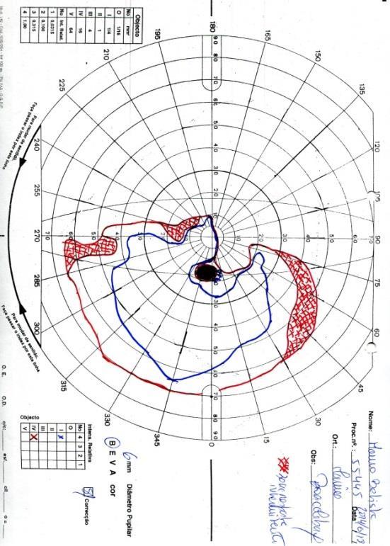 Evolução após a alta: Agosto de 2014 Assintomático ECA 87 U/L Hemograma, VS e PCR normais Função hepática e renal