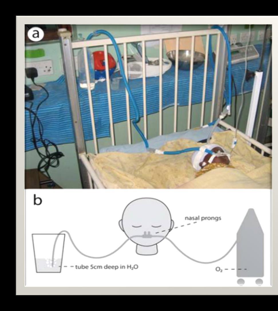 bcpap Nasal Por falta de recursos, foi utilizada uma instalação improvisada bcpap.