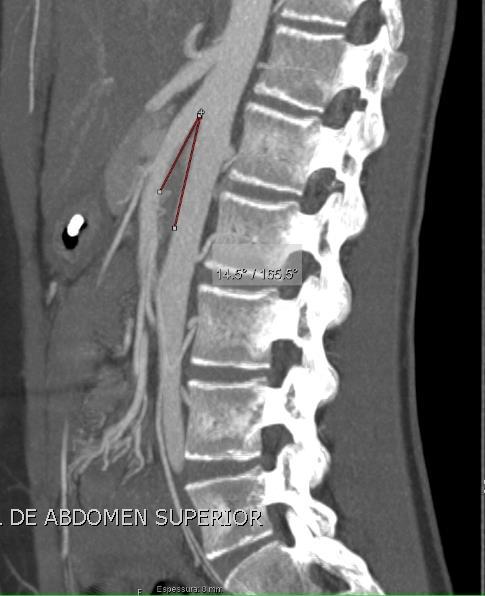 Síndrome de Wilkie Síndrome de Artéria Mesentérica Superior normally, the aortomesenteric angle and aortomesenteric distance