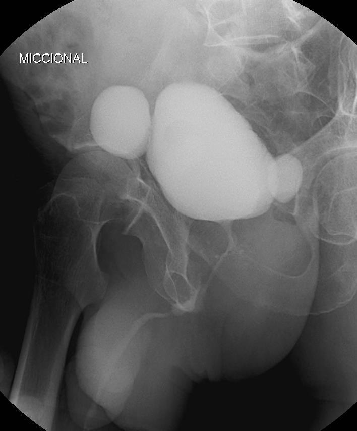 Fístula -