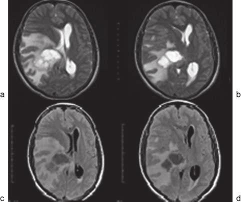 Fig. 2 Ressonância magnética (RM) de encéfalo em ponderação T2 (a) e (b). RM de encéfalo em ponderação T2 FLAIR (c) e (d).