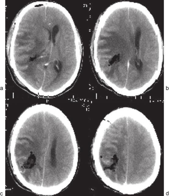 76 Criptococoma Cerebral Alvarenga et al. Fig. 3 Tomografia computadorizada (TC) de crânio pós-operatória imediata sem contraste (a) e (b).