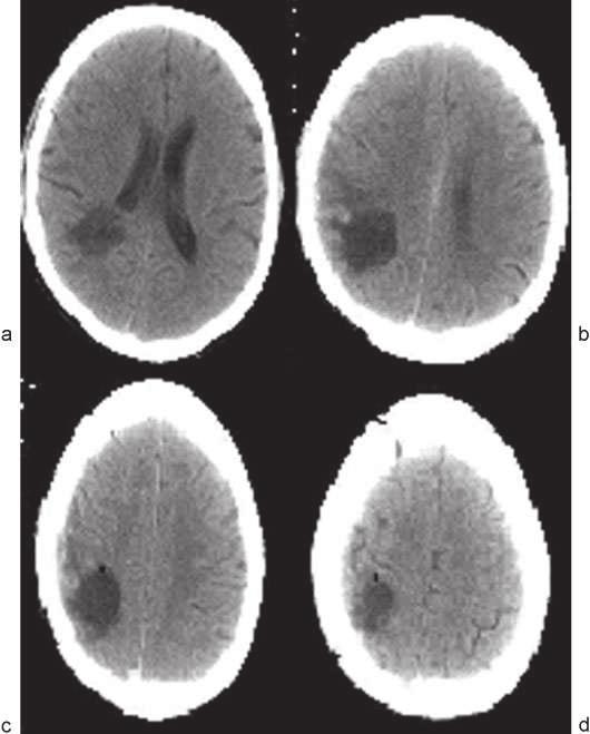 Criptococoma Cerebral Alvarenga et al. 77 Fig. 4 Tomografia computadorizada (TC) de crânio pós-operatória tardia (30 dias) sem contraste (a) e (b).
