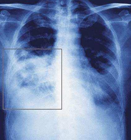 Pneumonia Diagnóstico: Sinais e sintomas e exame físico; RX do tórax; Exame de escarro, para diagnosticar o tipo de infecção;