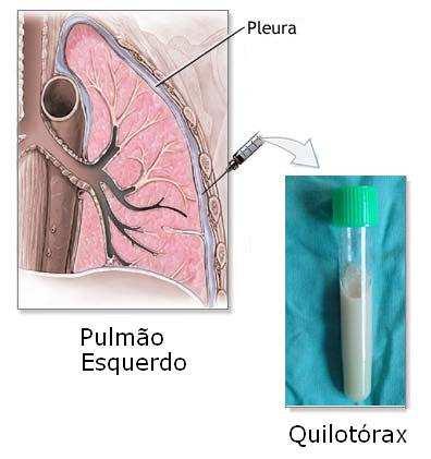 Diagnóstico: Pleurite Sinais e sintomas e exame físico (ausculta pulmonar); Rx do tórax;