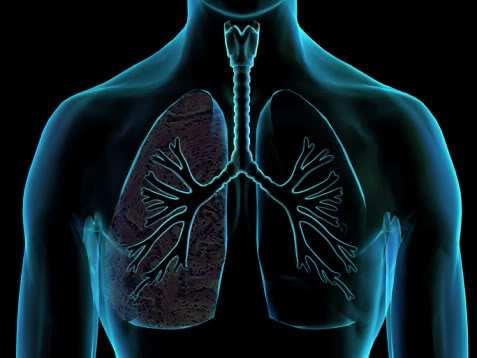 Bronquite Complicações: Bronquiectasia; Enfisema pulmonar; Diminuição da resistência orgânica, predispondo a outras doenças do